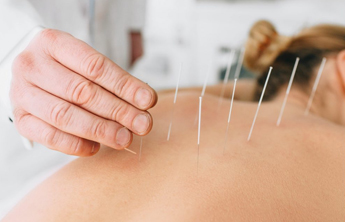 Dry needling